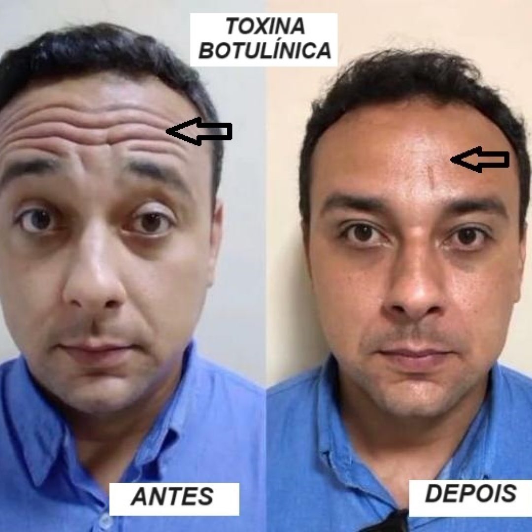 Toxina botulínica 3