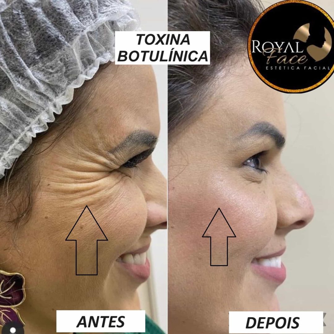 Toxina botulínica lateral-min (1)