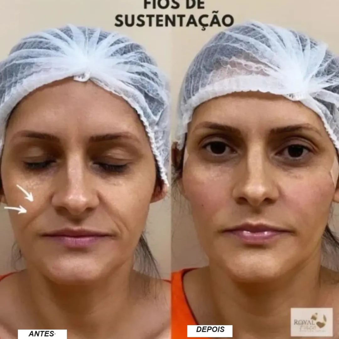 araguari_fios de sustentação