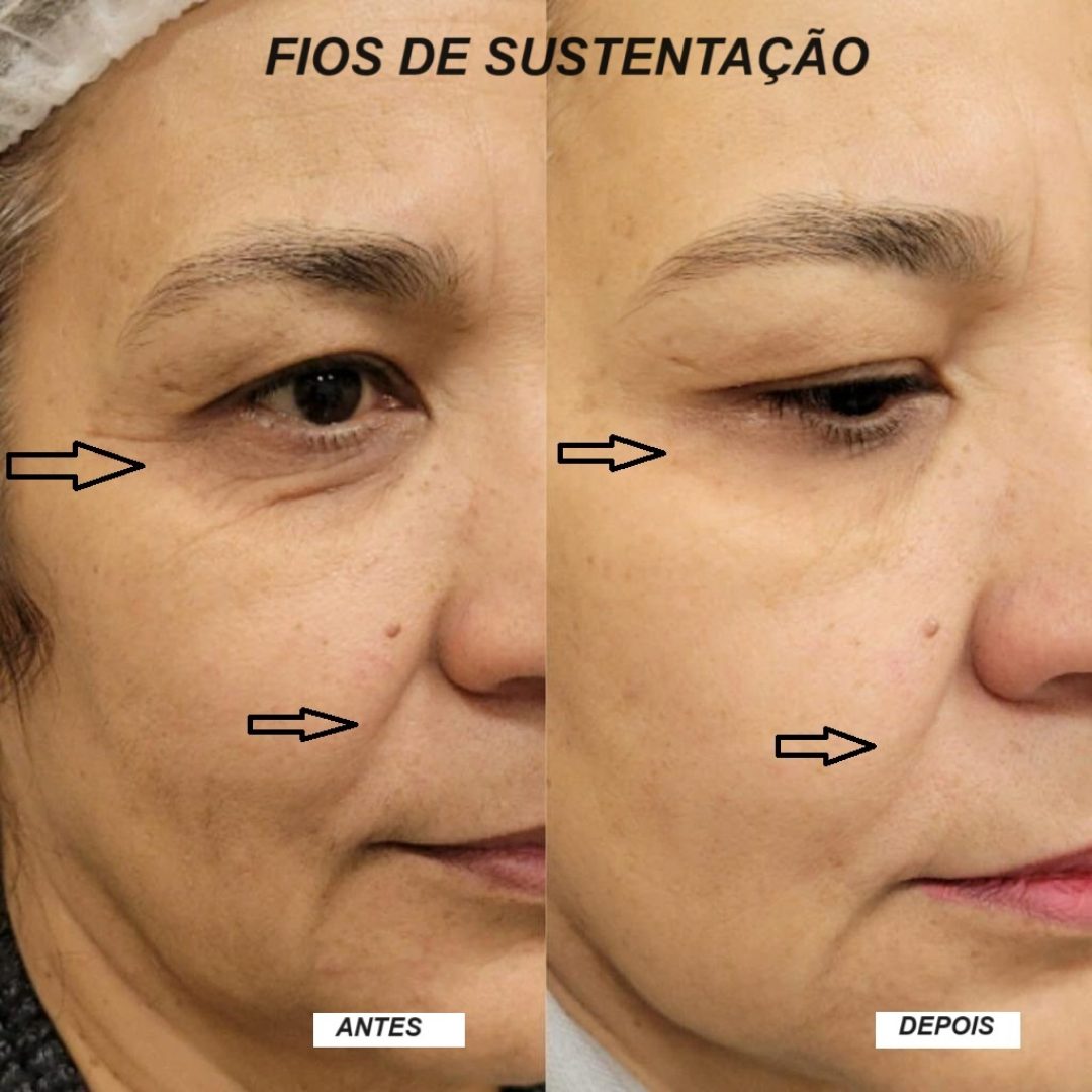 fios de sustentação